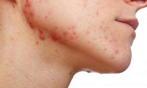 Acne in Adults photo